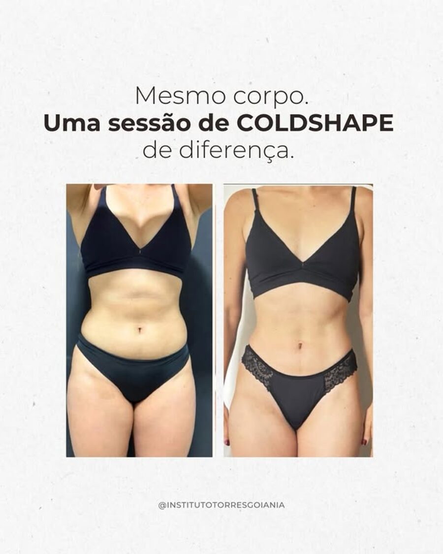 Antes e depois de uma sessão de criolipólise ColdShape no Instituto Torres